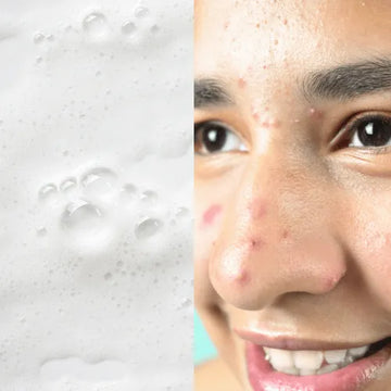 Anti-acne solution by Forganica Skincare by Dr Faiza Shams targeting pimples and breakouts.
