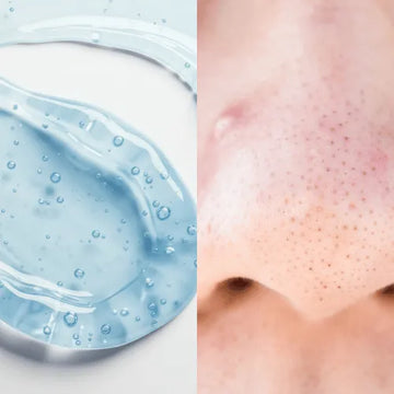 Close-up of nose with blackheads and whiteheads (comedones) treated with Forganica Skincare by Dr Faiza Shams in Pakistan for clear, smooth skin.