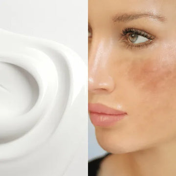 hyperpigmented skin treatment by forganica skincare