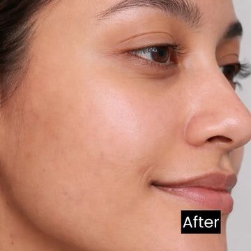 Pigmentation Solutions