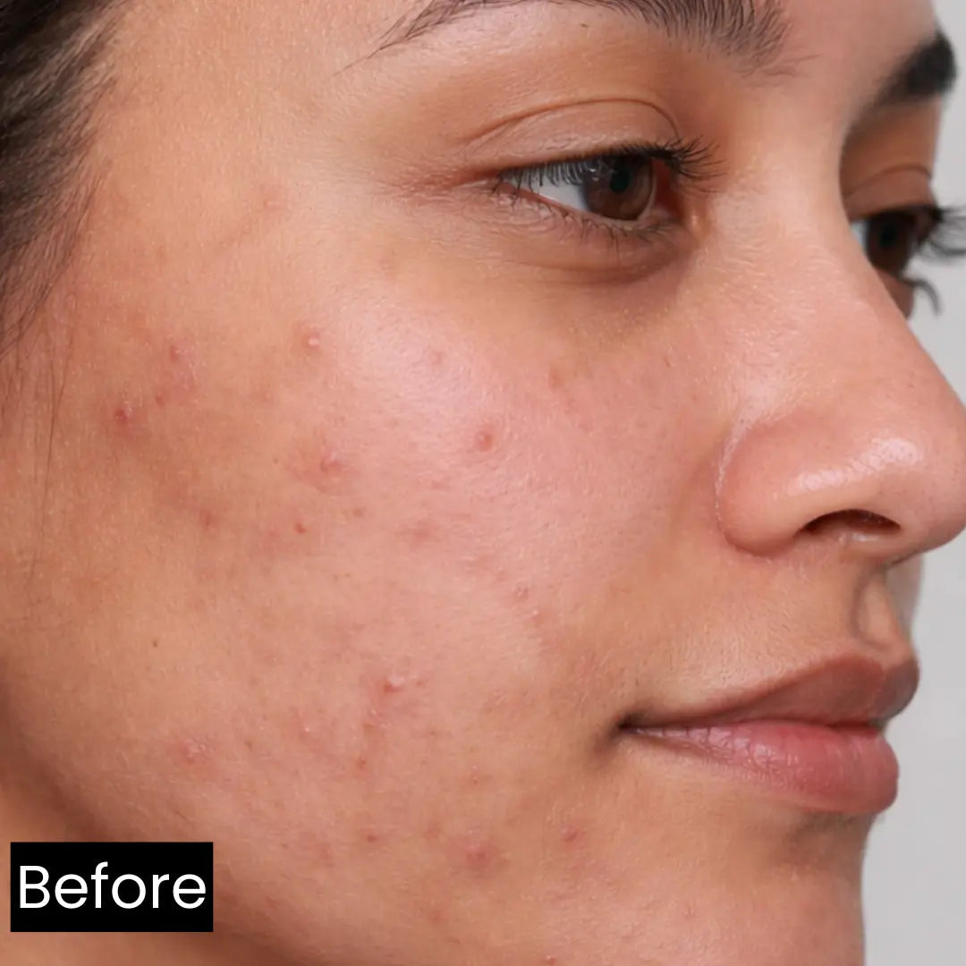 Before and after results using Forganica Serum for skin brightening, acne marks, and radiant skin