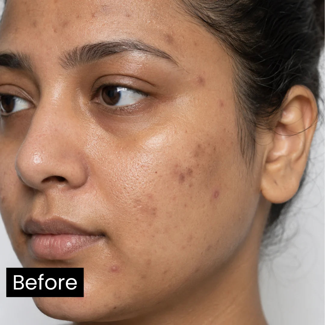 Befor_using_silymarin_antioxidant_serum-Forganica_molecular_skincare