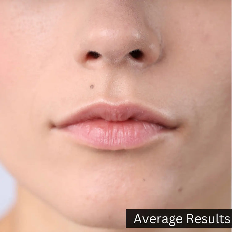 Before and after Hyaluronic Acid Serum results for dry skin hydration and skin barrier repair by Forganica