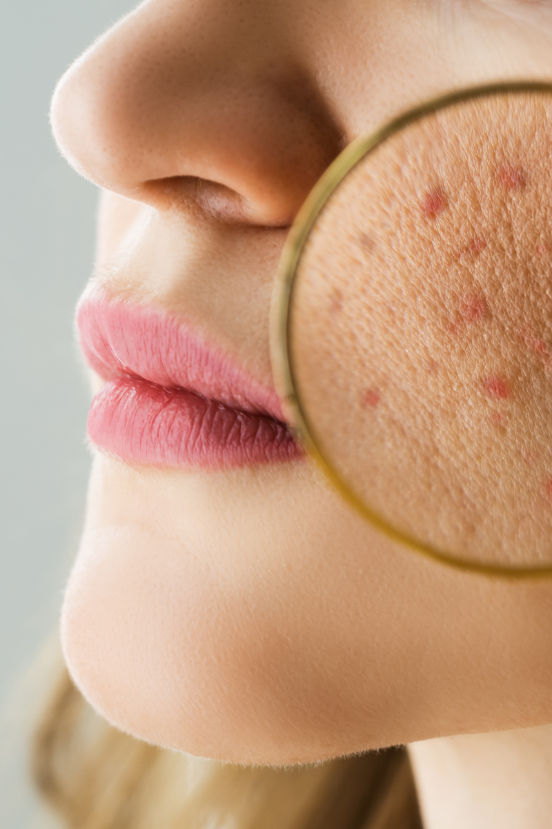 Close-up_of_a_woman_s_cheek_under_magnifying_glass_showing_acne_and_clogged_pores_highlighting_skin_inflammation_and_breakout.forganica_skincare_shop_by_skin_concern