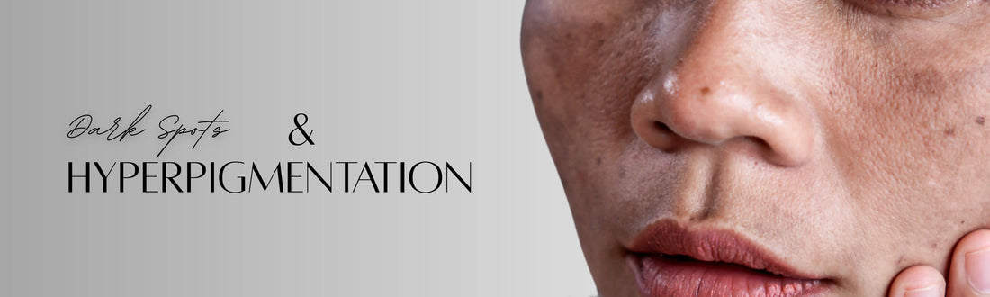 Forganica_Skincare_Hyperpigmentation_and_dark_spots_banner_highlighting_skin_discoloration_treated_with_molecular_brightening_actives.