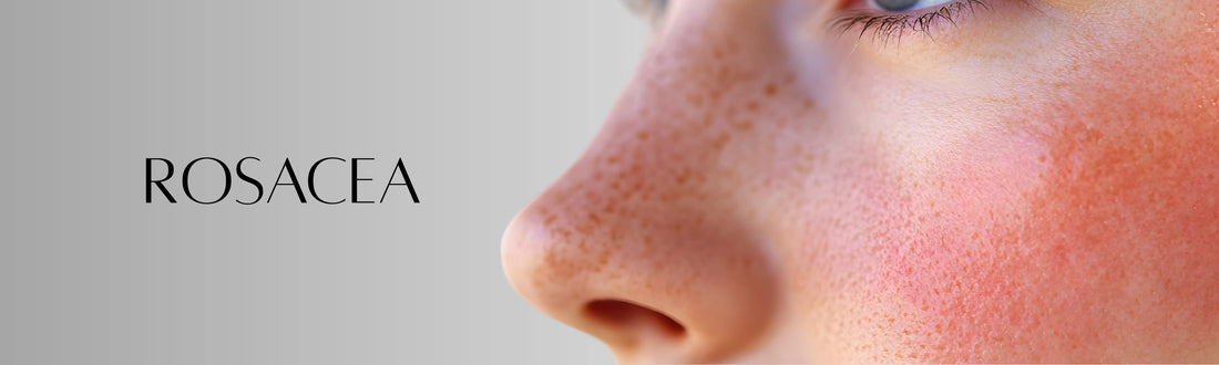 Forganica_Skincare_Rosacea_banner_showing_facial_redness_and_irritation_representing_molecular_skincare_solutions_for_sensitive_redness-prone_skin.