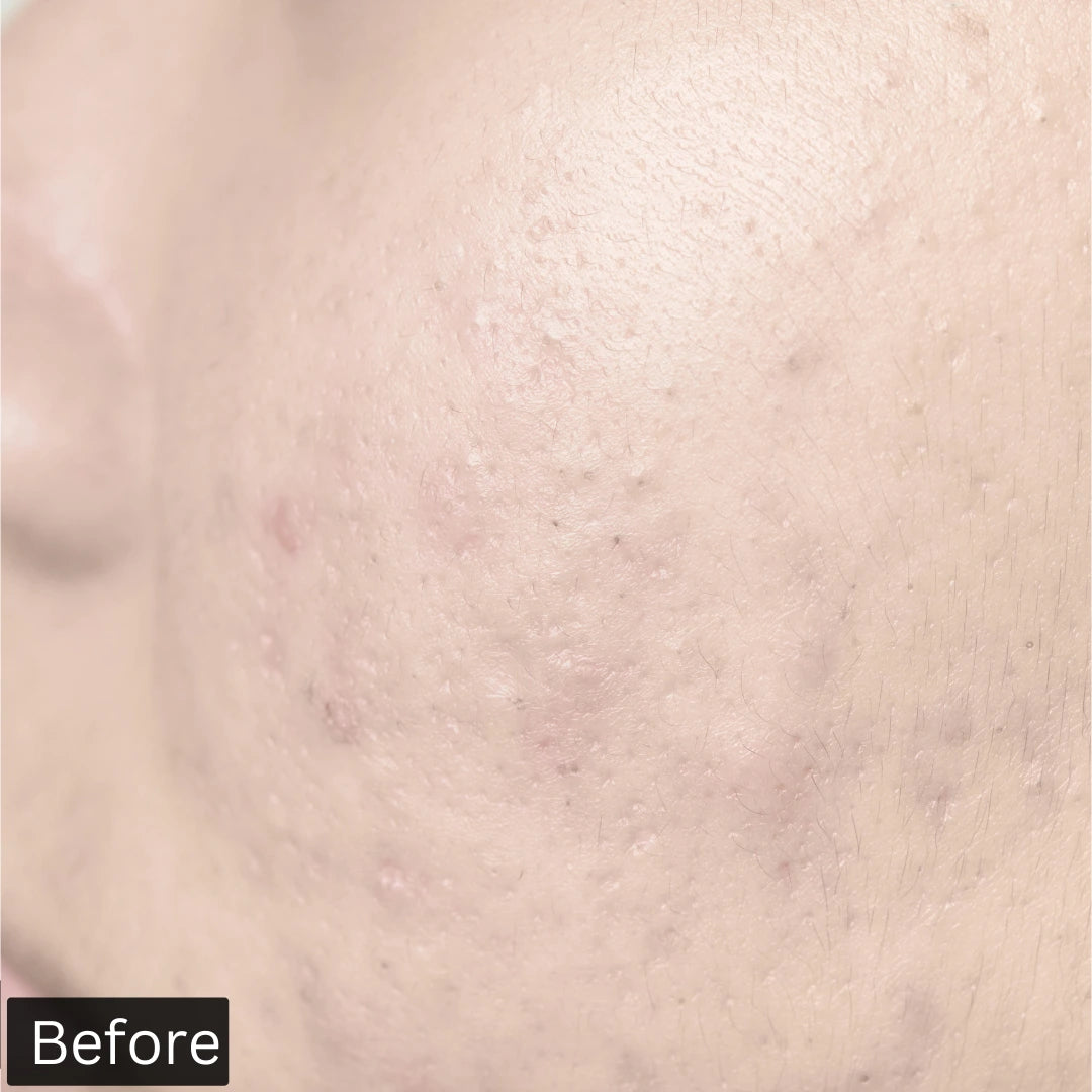 before using forganica salicylic acid serum