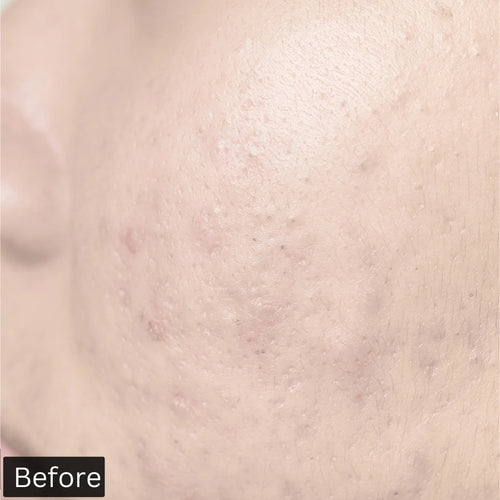 before using forganica salicylic acid serum
