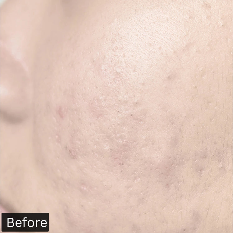 before using forganica salicylic acid serum