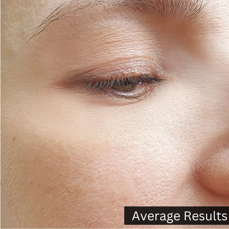 average results after using hyaluronic acid serum image