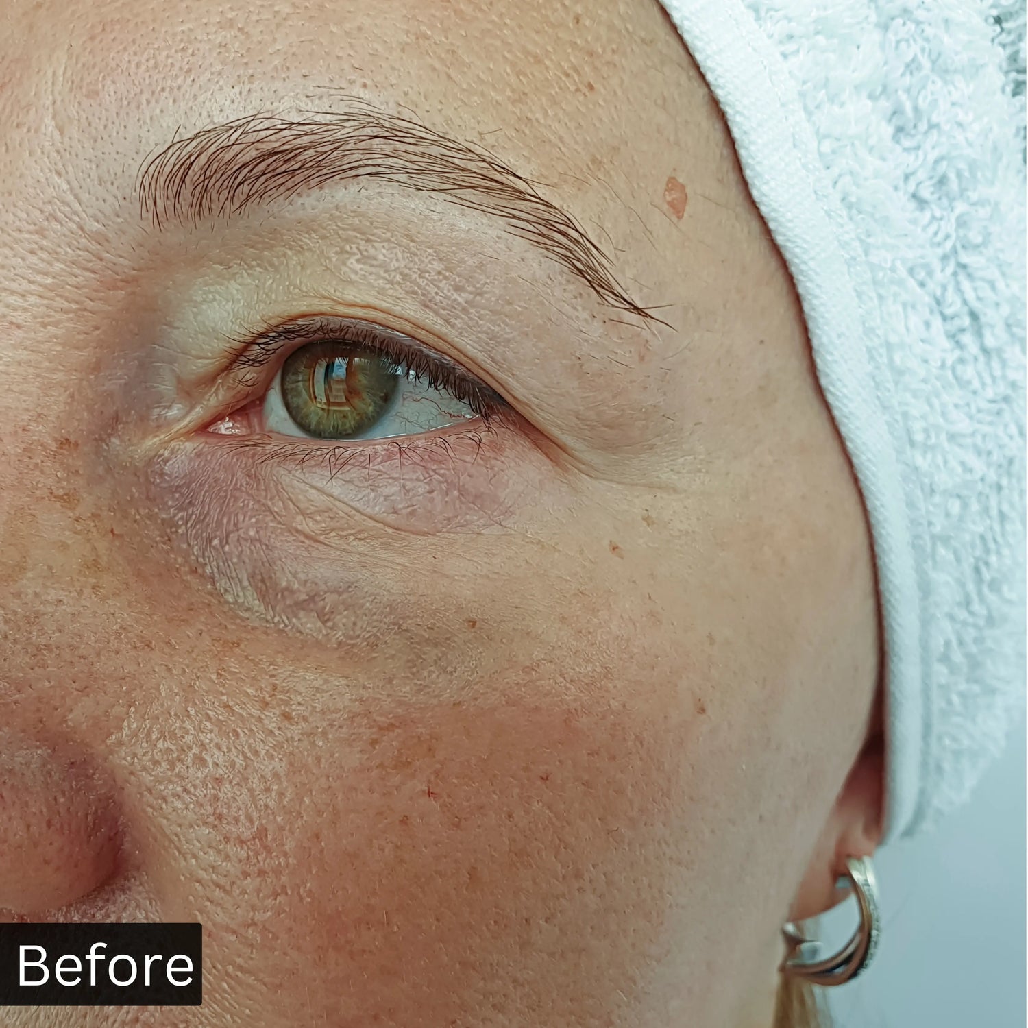 before_and_after_results_of_using_niacinamide_serum before using 