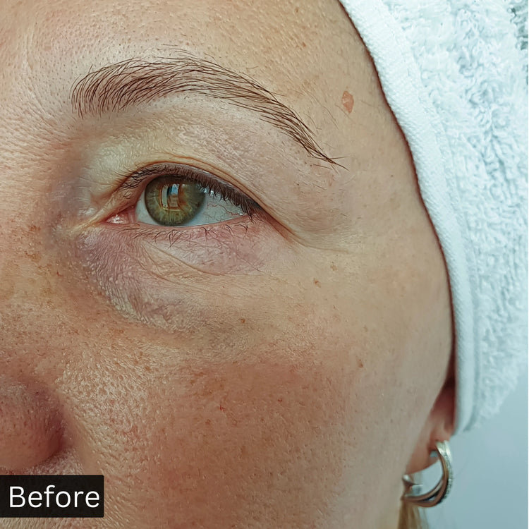 before_and_after_results_of_using_niacinamide_serum before using 
