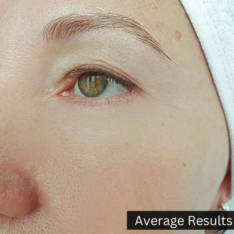 before_and_after_results_of_using_niacinamide_serum_after_image of customer 