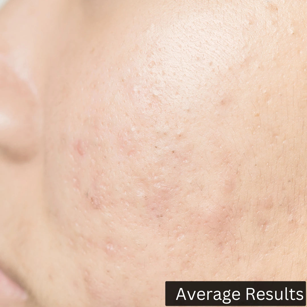average results after using forganica salicylic acid serum