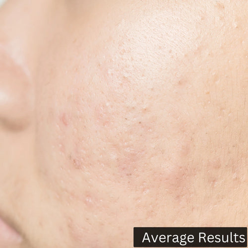 average results after using forganica salicylic acid serum